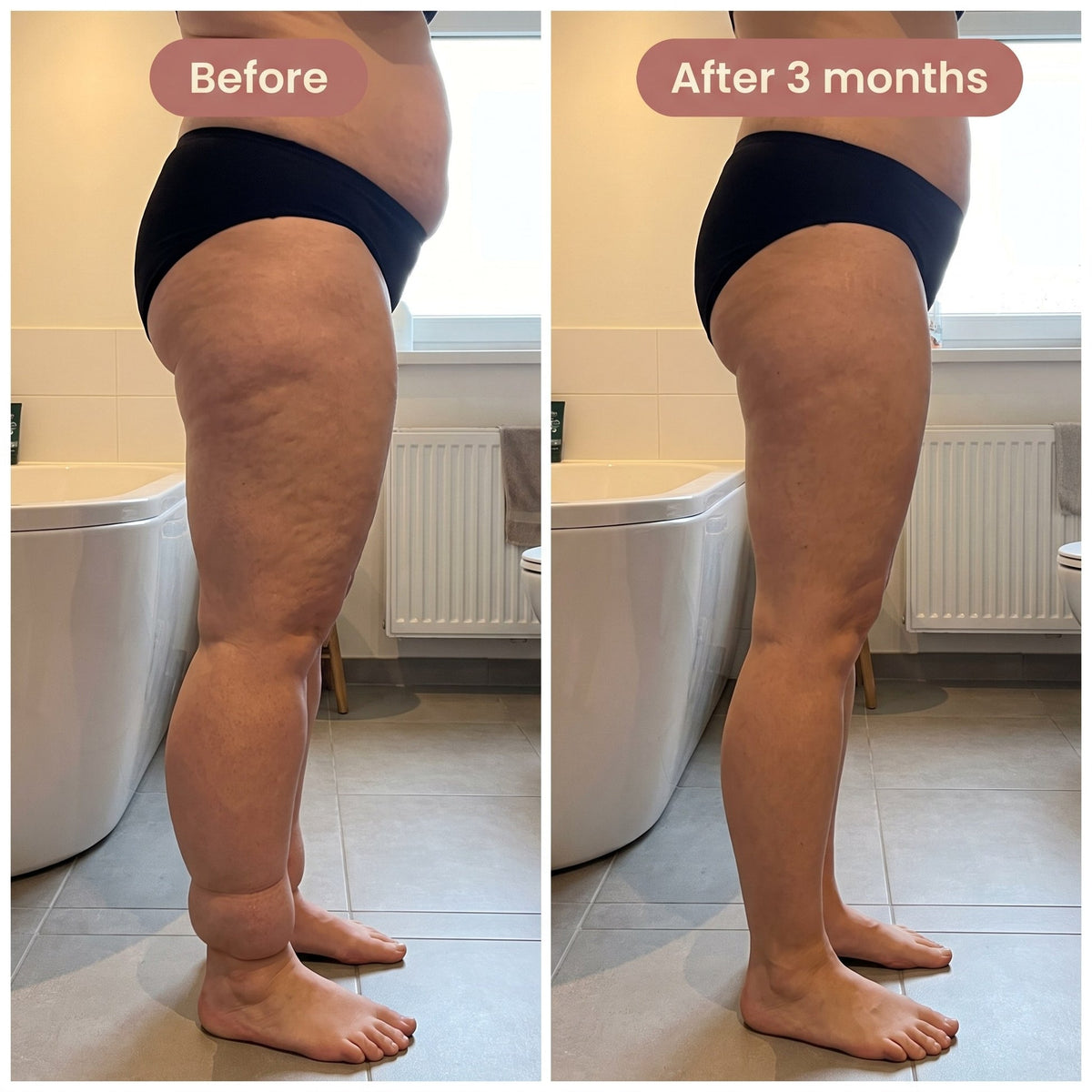 Lipedema 4D Sculpting Leggings