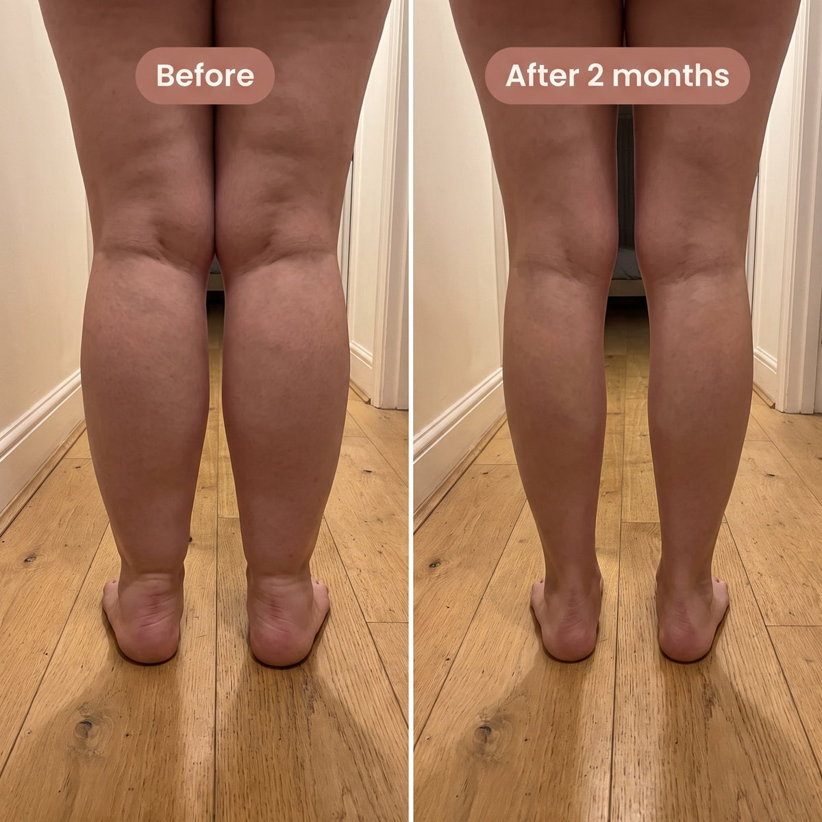 Lipedema 4D Sculpting Leggings